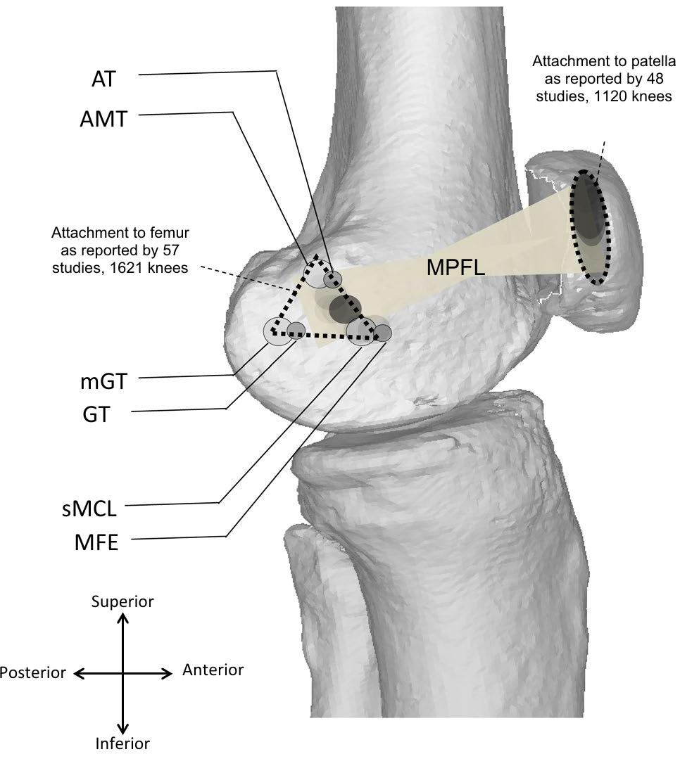 (PDF) Origin and insertion of the medial patellofemoral ligament: a ...