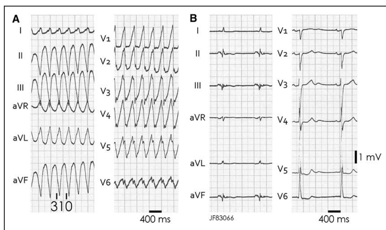 Ft. [2-lea@ ecg auring vi ana sinus rythm. a, ecg of the