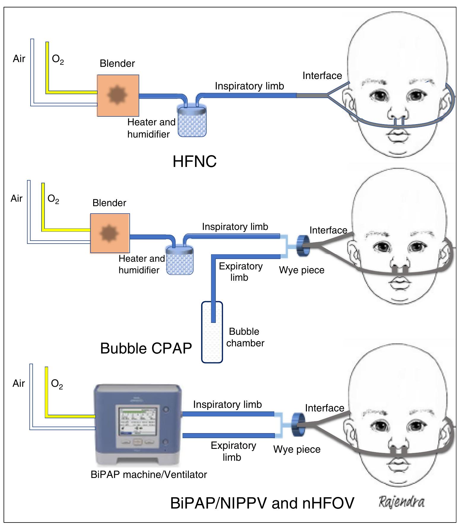 (PDF) Noninvasive Respiratory Support in Neonates: A Review of Current ...