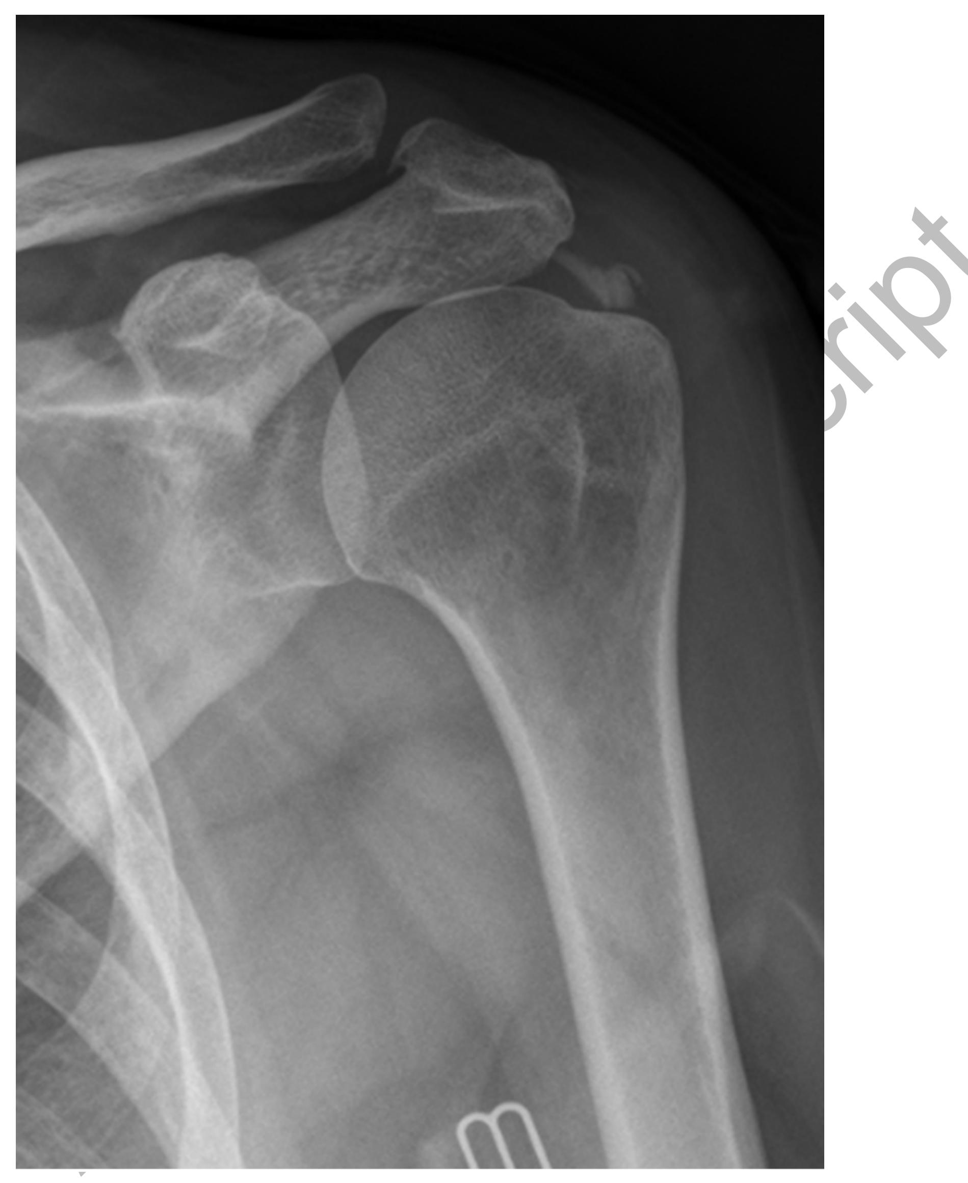 (PDF) Calcific tendinopathy of the rotator cuff: a review of operative ...