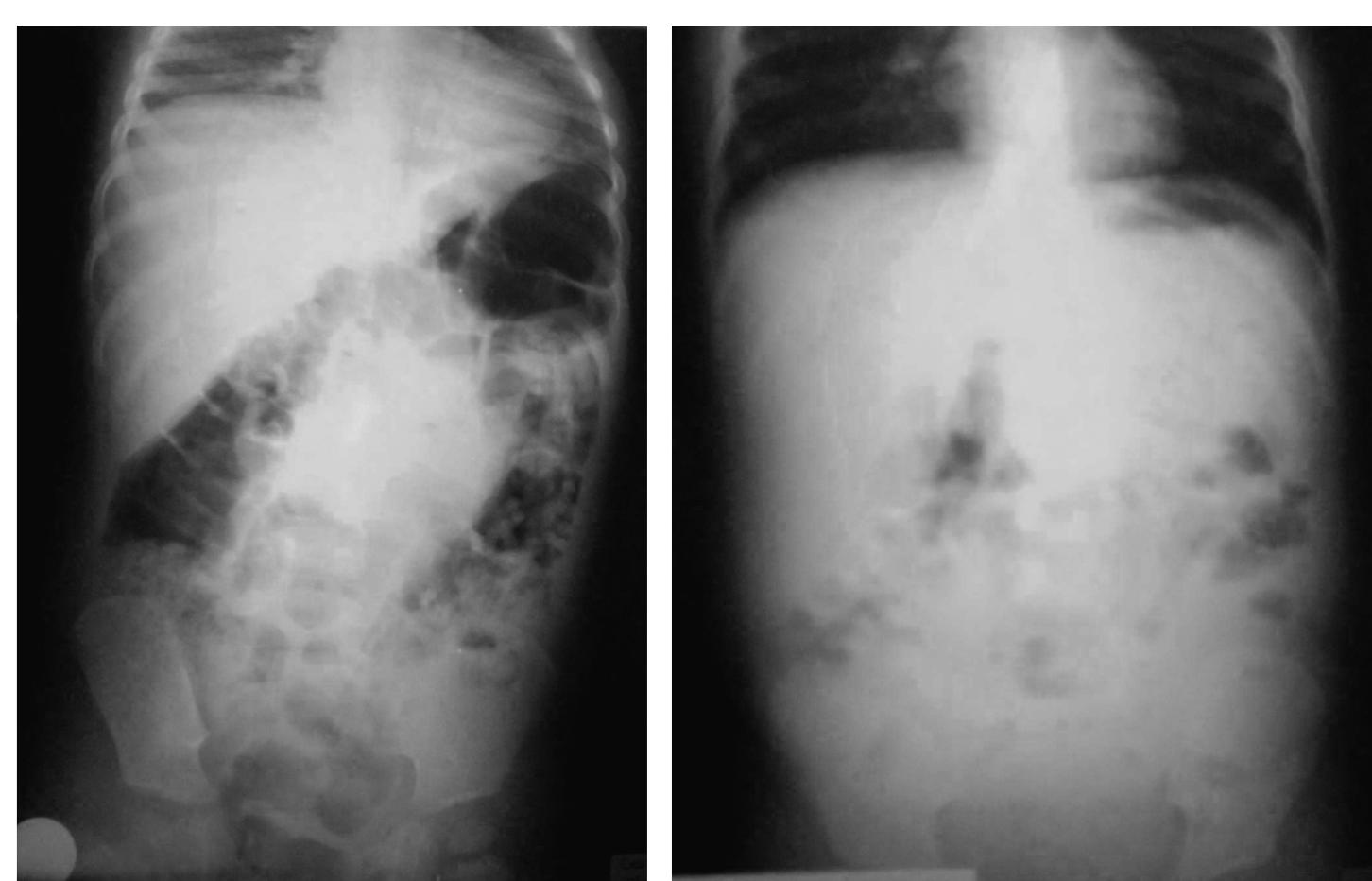 Obstruction Left (PDF) Surgical Diagnosis and Management of Intestinal Obstruction Due ...