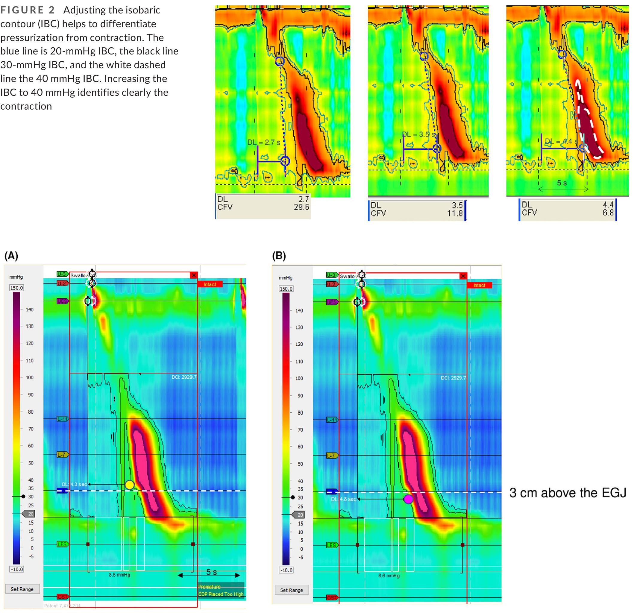 (PDF) Chicago Classification Update (v4.0): Technical review on ...