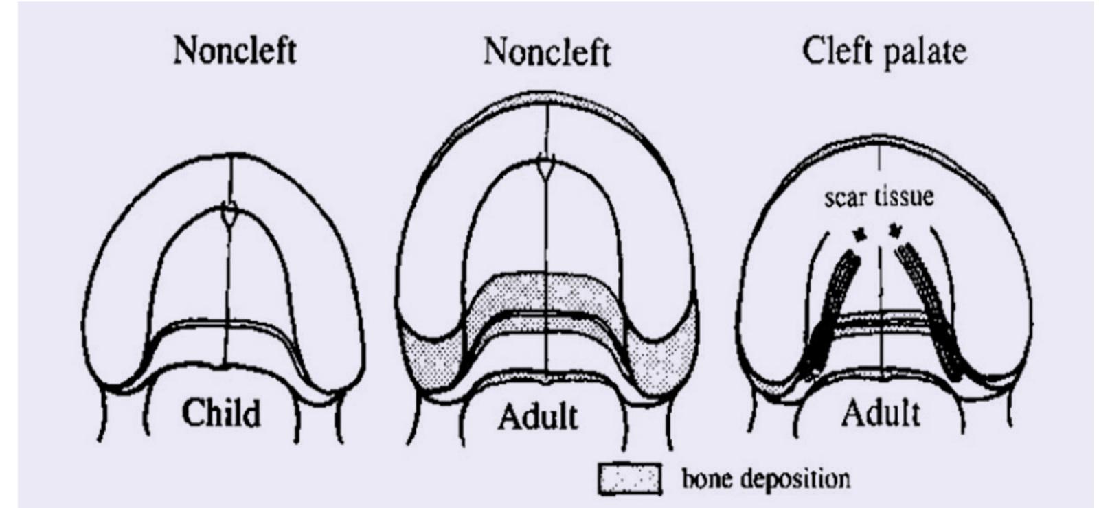 (PDF) The Prevalence of Cleft Lip and Palate and Their Effect on Growth ...