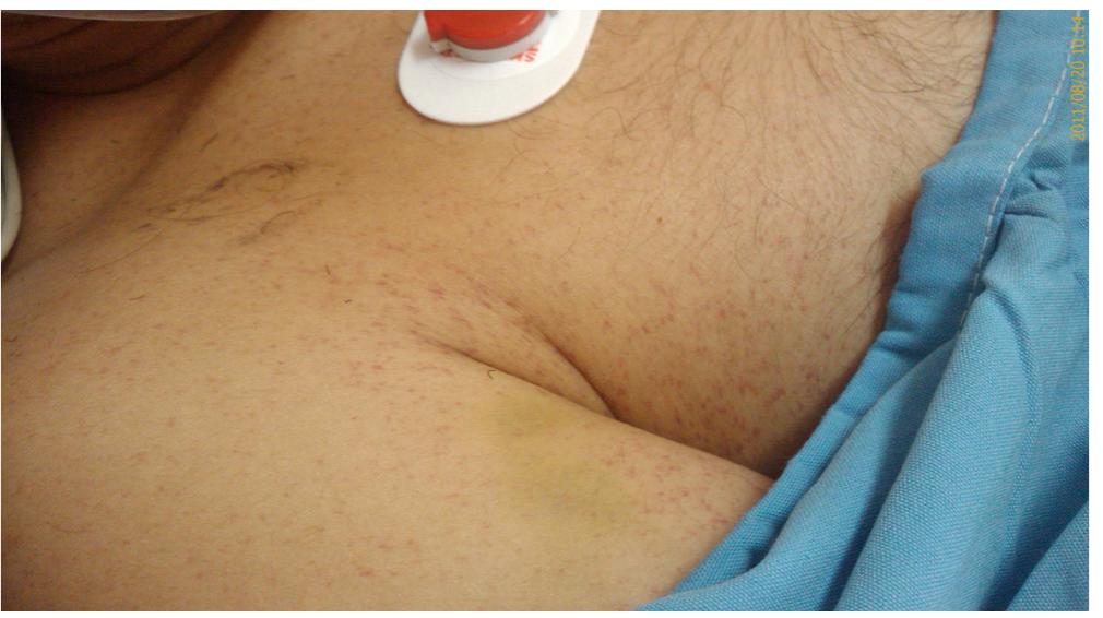 (PDF) Motor aphasia as a rare presentation of fat embolism syndrome; a ...