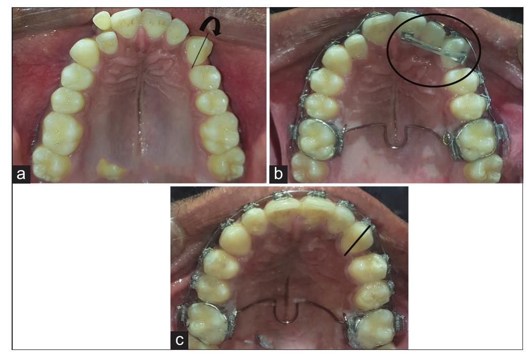 (PDF) Management and retraction of rotated canines by different methods ...