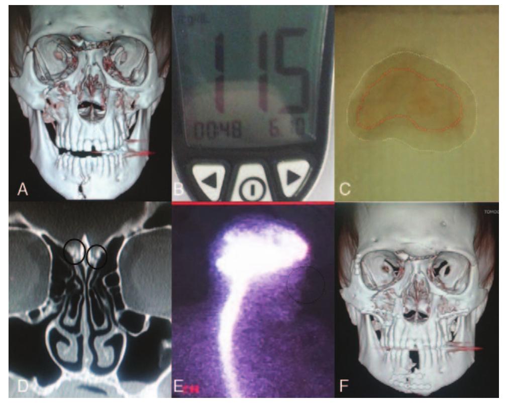 (PDF) Diagnosis and Management of Cerebrospinal Fluid Leak in a ...