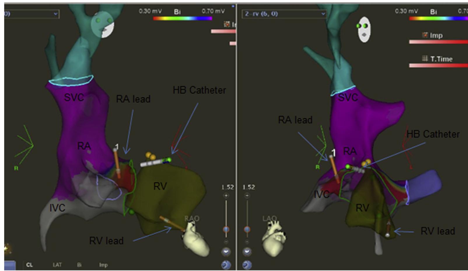 (PDF) Permanent pacemaker implantation without fluoroscopy in a ...