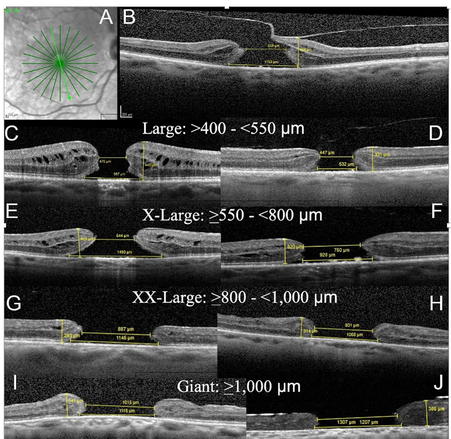 Um 293 (PDF) Surgical classification for large macular hole: based on ...