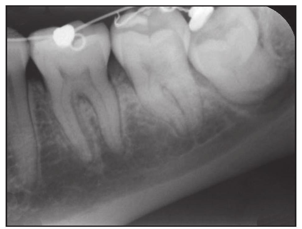 Figure 6 - Orthodontic extraction of a mandibular third