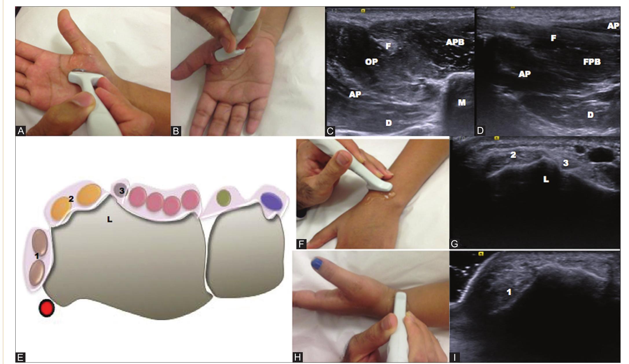 Testing Epl Tendon (PDF) Thumb ultrasound: Technique and pathologies