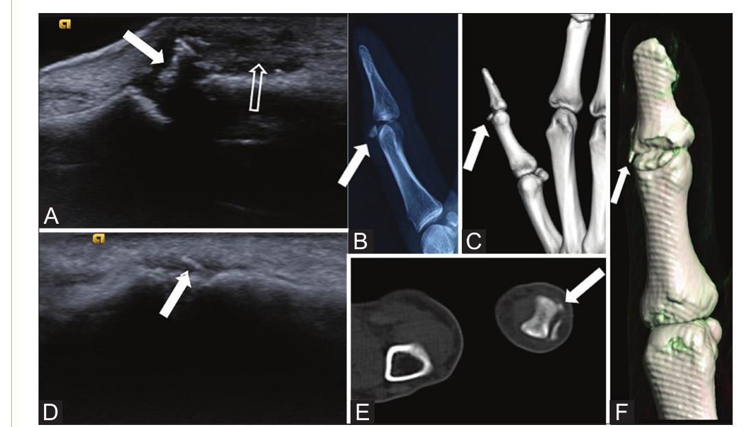 Baser Rcl (PDF) Thumb ultrasound: Technique and pathologies
