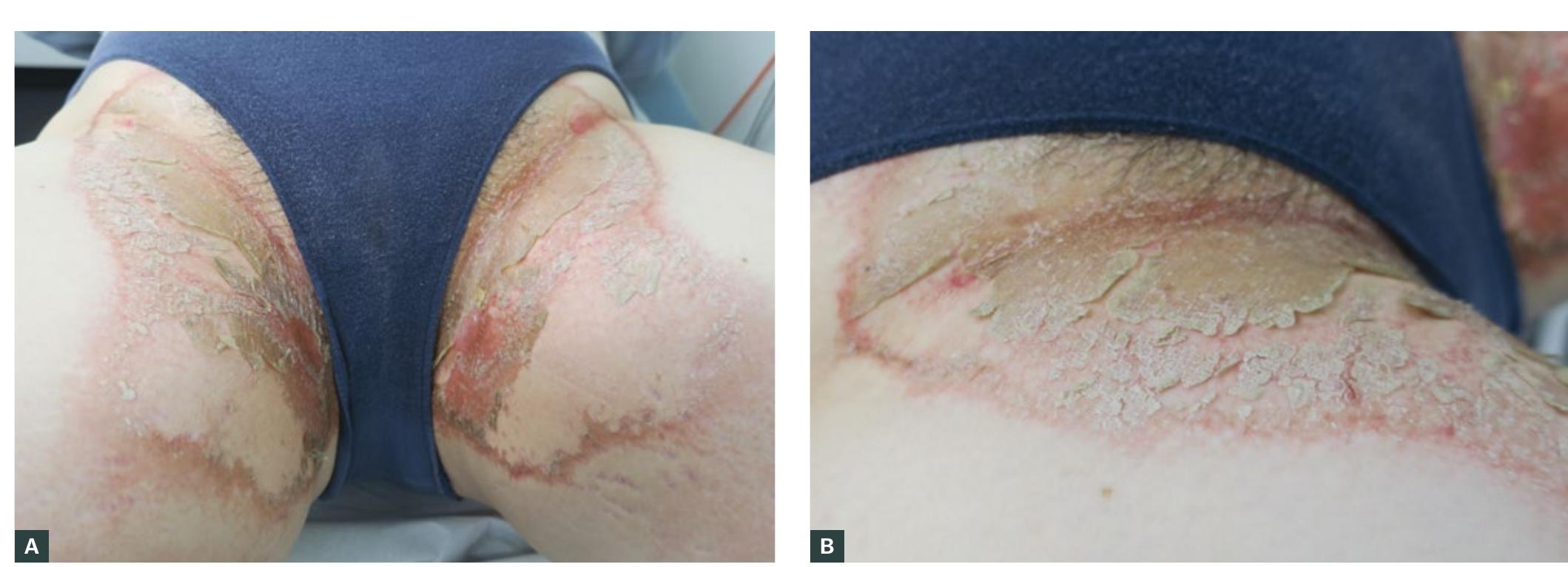 Groin Rash Reaction (PDF) A red scaly rash to the groin