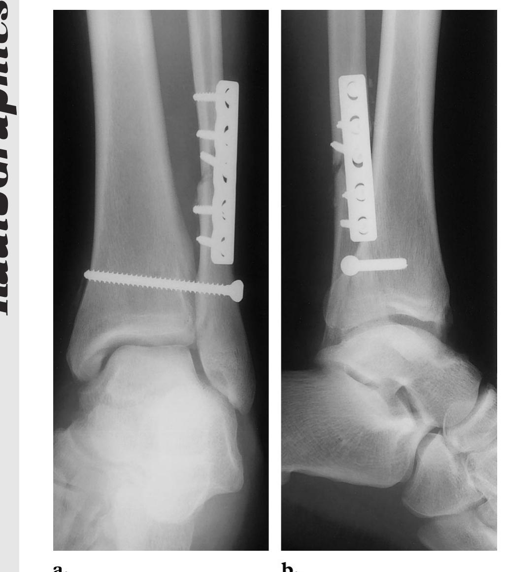 Transfix Screw (PDF) Fracture Fixation