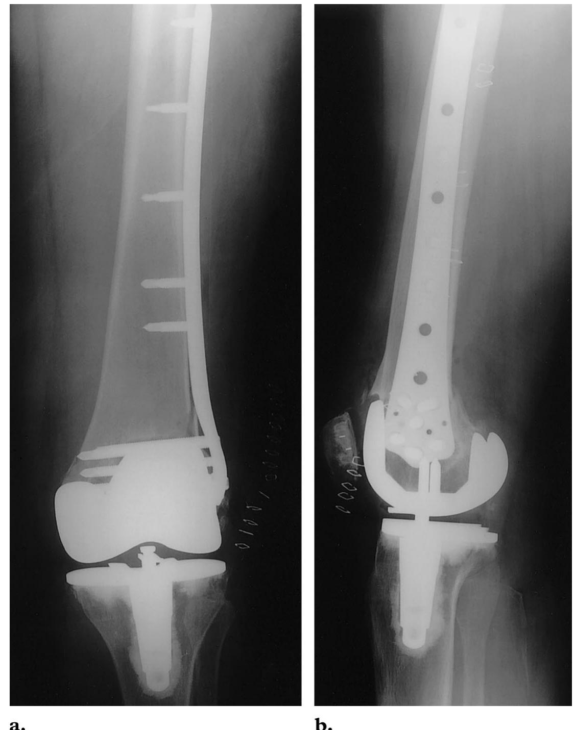 (PDF) Fracture Fixation