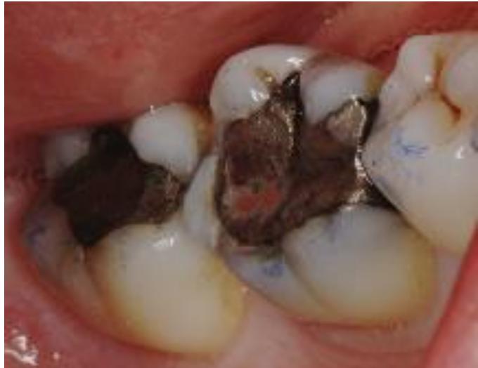 Lr6 Tooth (PDF) Cracked tooth syndrome diagnosis part 1: integrating the old with ...