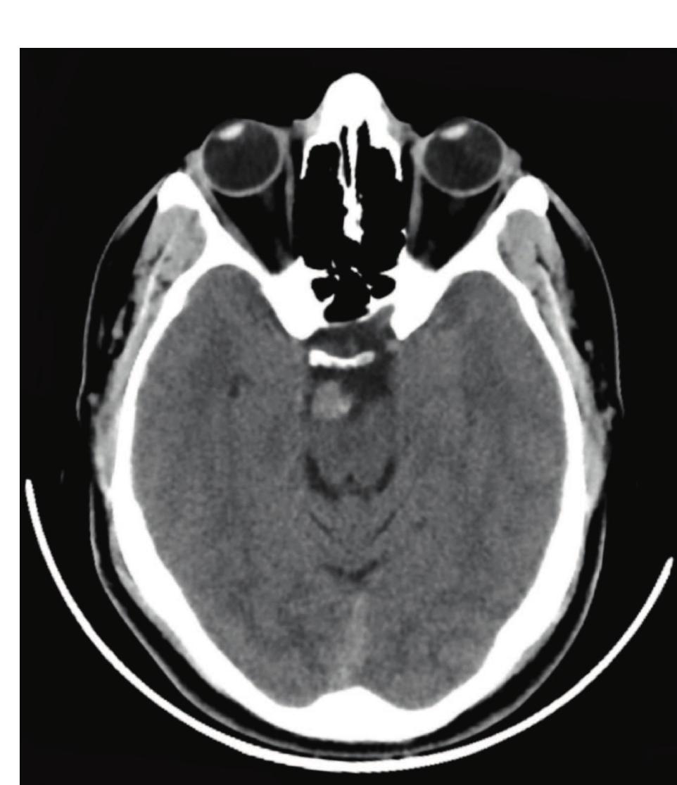A non-enhanced axial ct scan of the brain revealing a