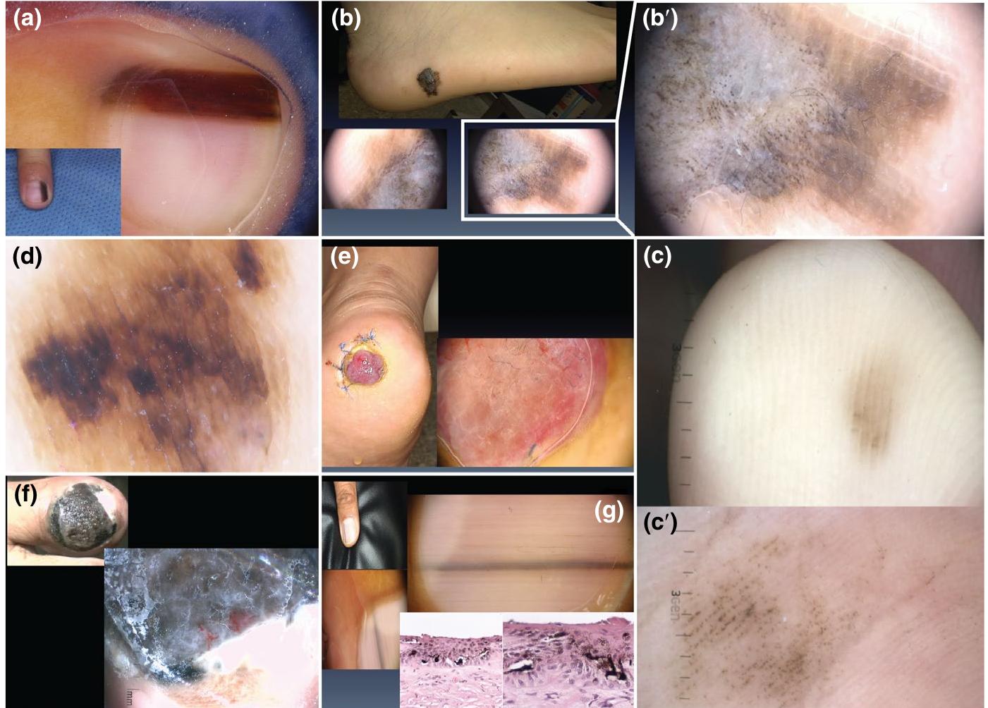 (PDF) Acral lentiginous melanoma: Basic facts, biological ...