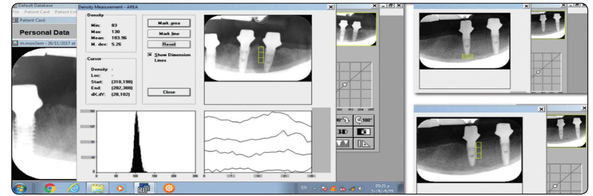 Digora Software (PDF) Assessment of Bone Density Changes Around Two Versus Four ...