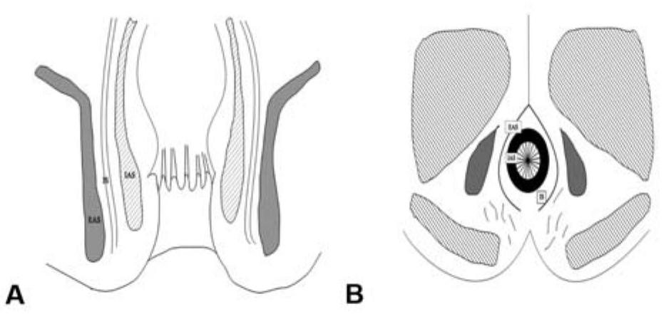 Figure 8 - from Fistula in Ano-A 2-Year Prevalence Study on