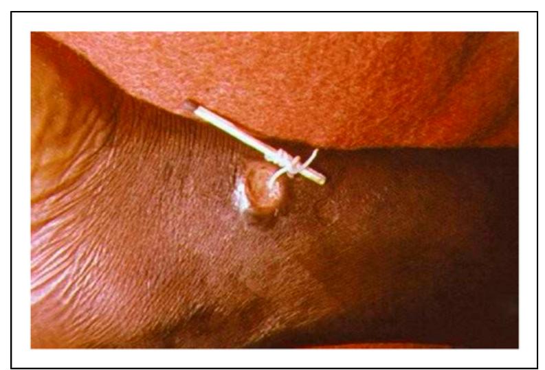 Figure 3. Guinea worm extraction  12  that I will fulfill according to my ability and 