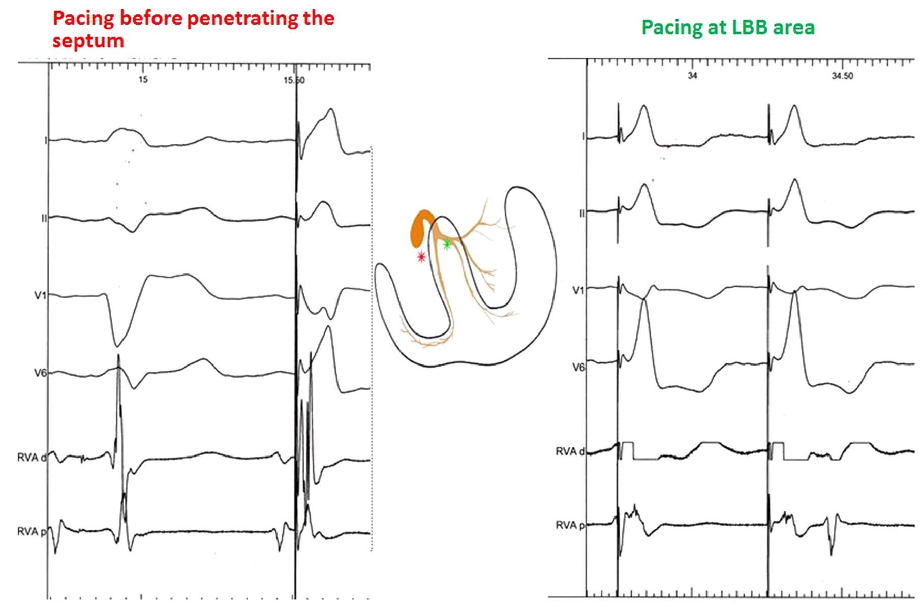 (PDF) Left bundle branch area. A new site for physiological pacing: a ...