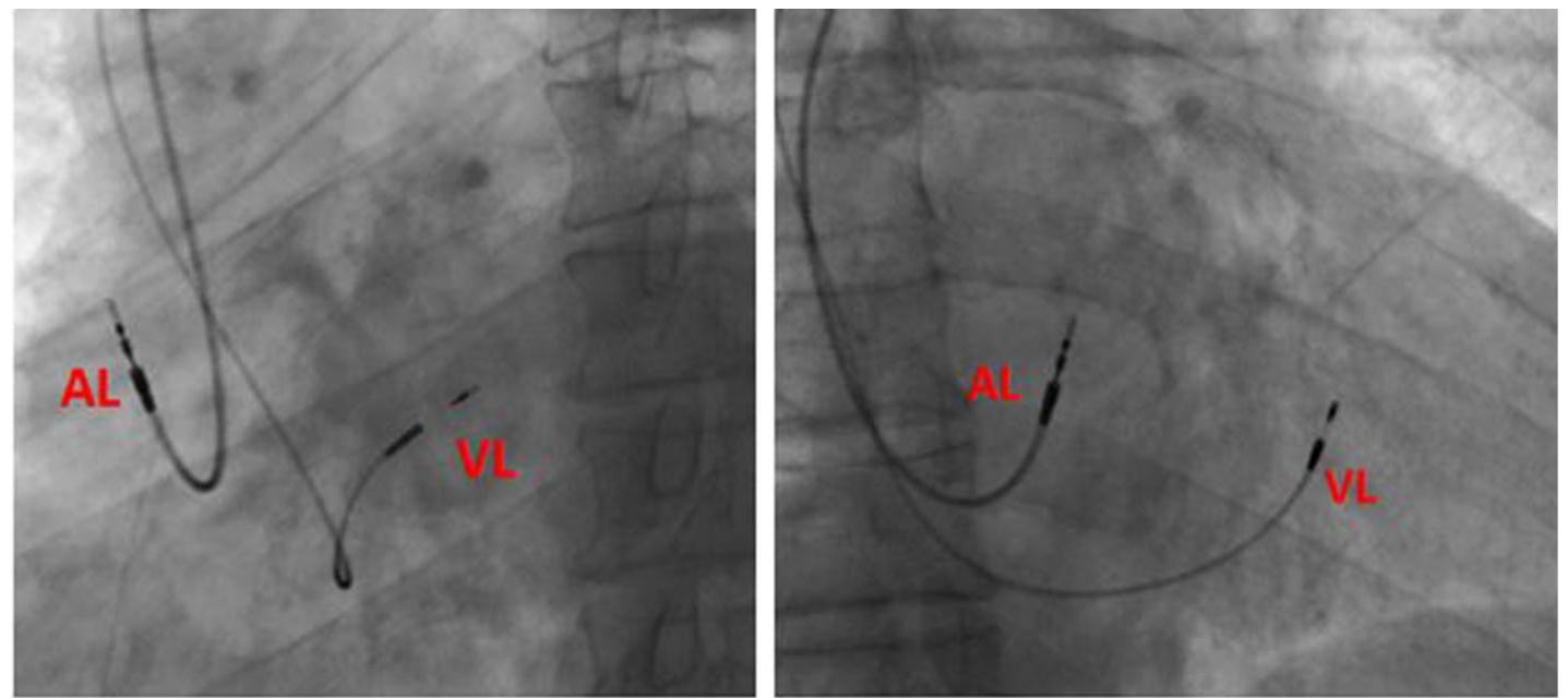 Tricular (PDF) Left bundle branch area. A new site for physiological pacing: a ...