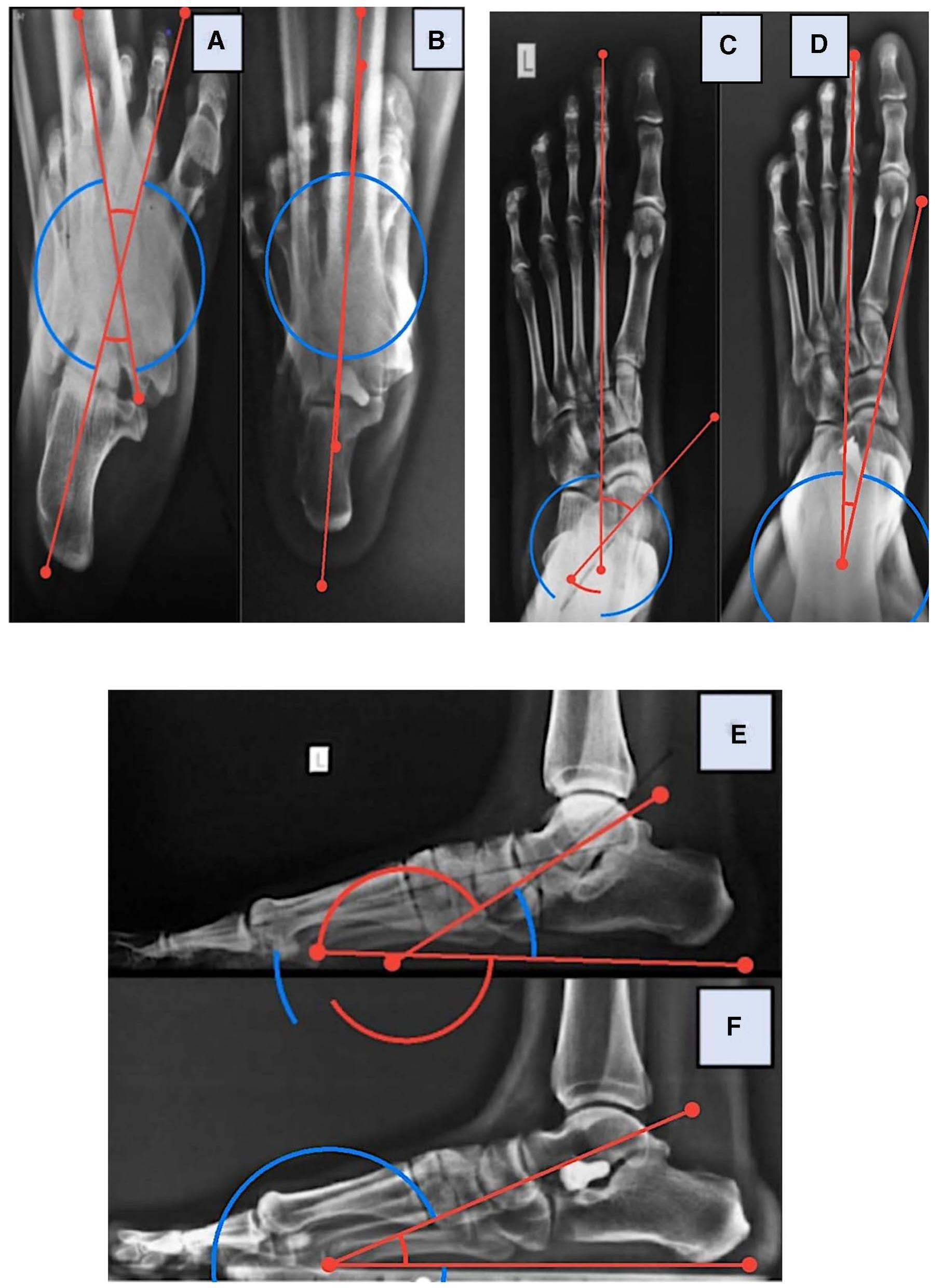 Talar Angle (PDF) Short Term Clinico-Radiological Outcome of Extra Osseous Talo ...