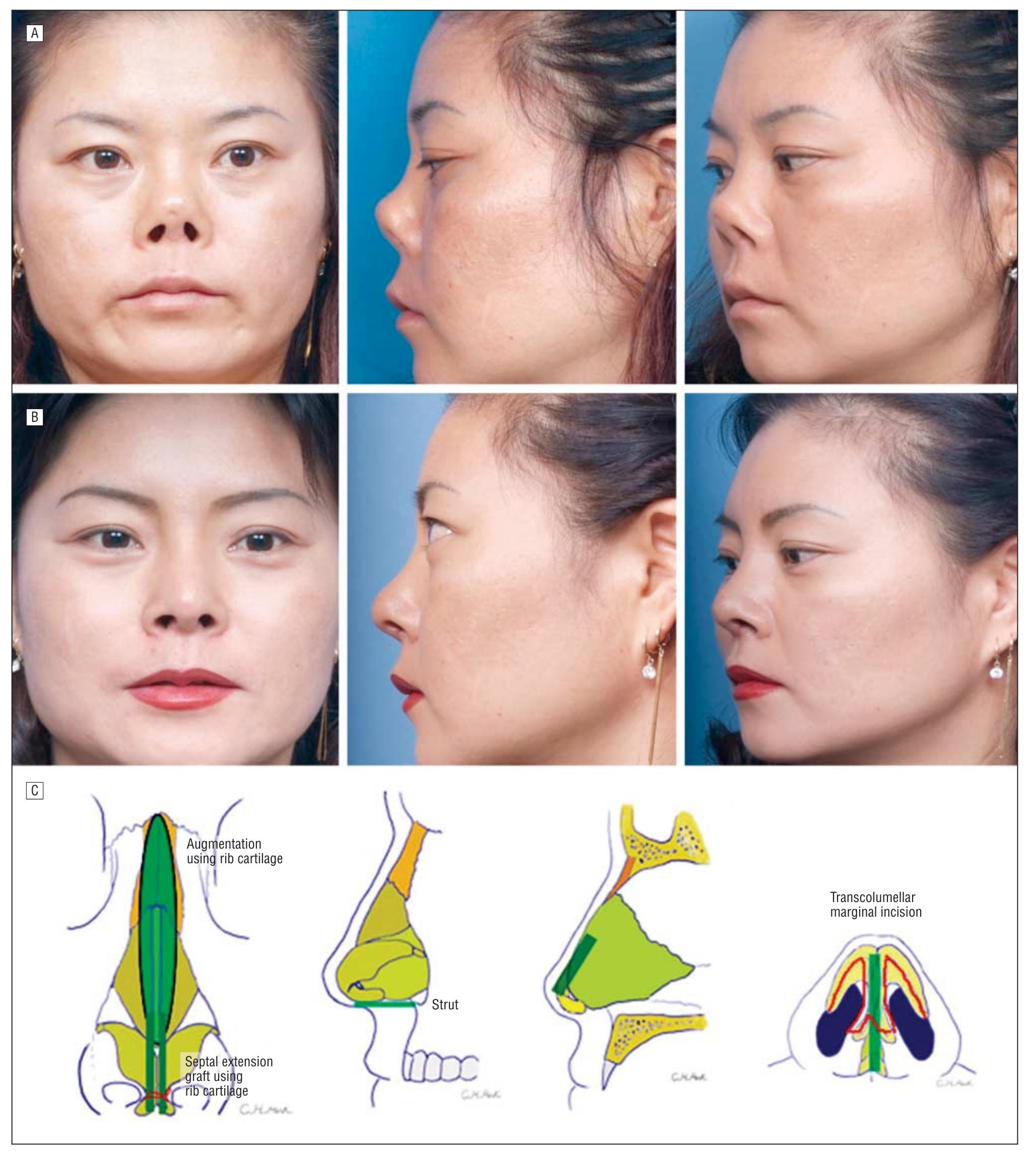 (PDF) Revision rhinoplasty of asian noses analysis and treatment