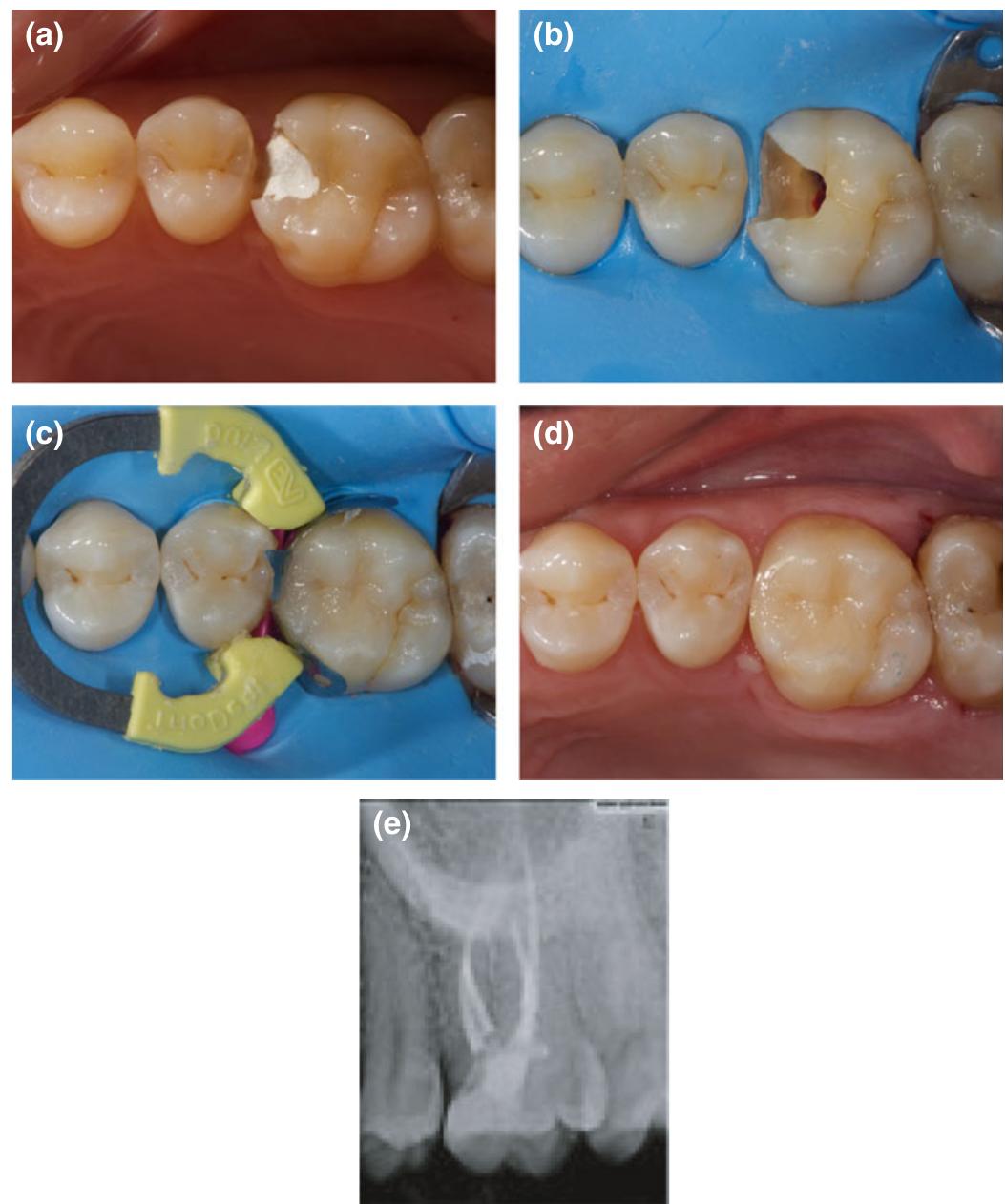 Radiographic sequence of crown lengthening on tooth 27.
