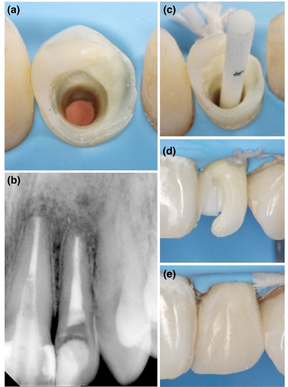 Radiographic sequence of crown lengthening on tooth 27.