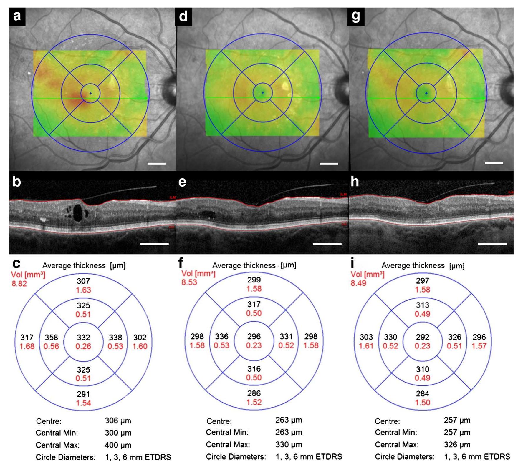 Oct Color Map Sd-oct images and macular thickness maps of an eye before