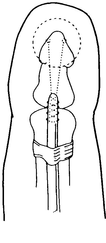 Fdp Button (PDF) Bone suture anchors versus the pullout button for repair of ...