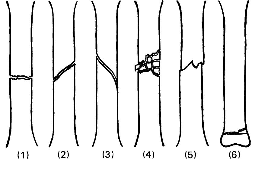Math Simple Fracture (PDF) An Introduction to Fractures