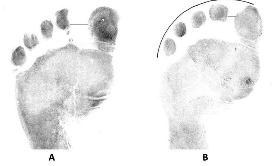 Normal Toe Print (PDF) Emergence of forensic podiatry—A novel sub-discipline of forensic ...