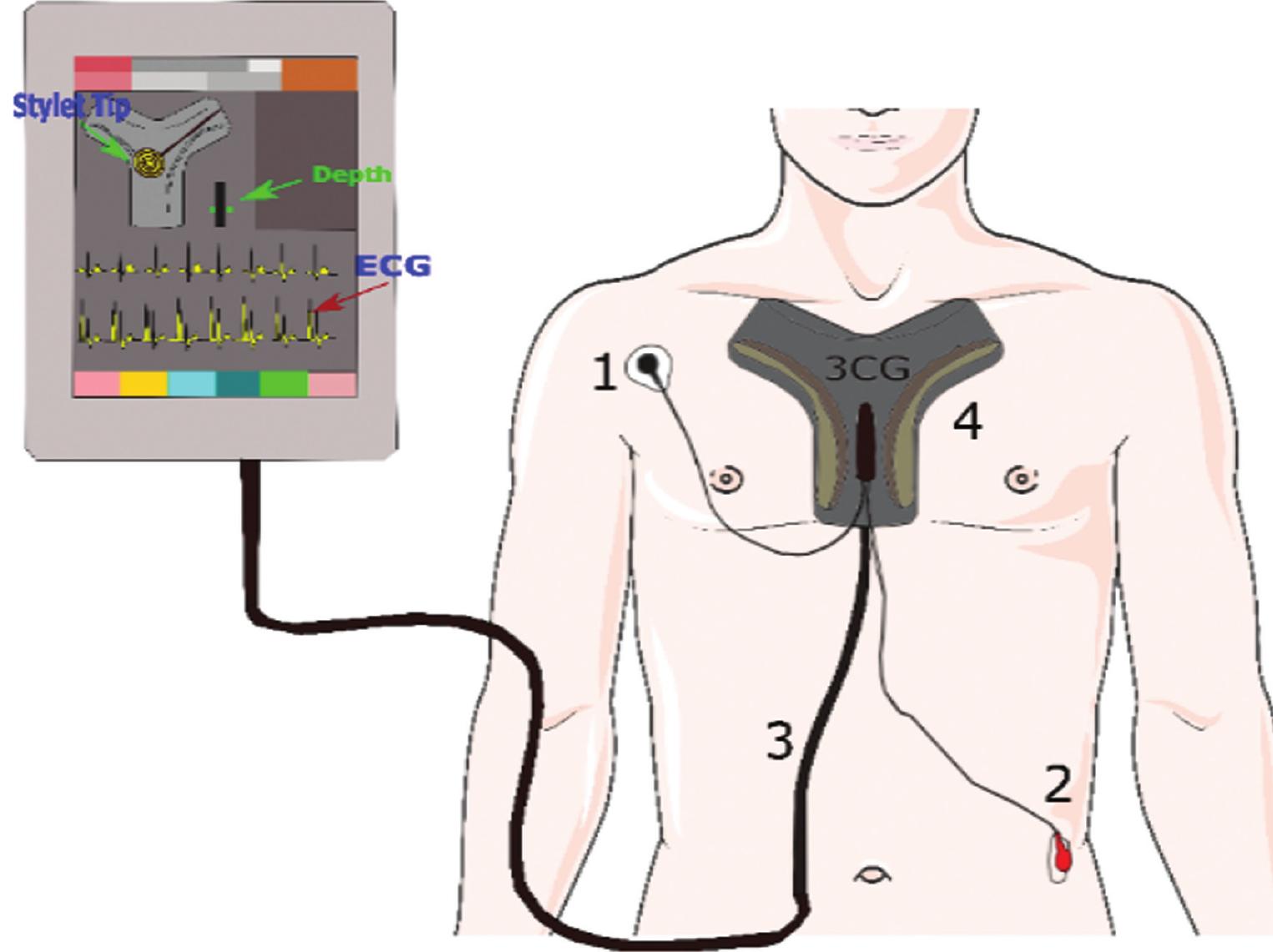 Electrocardiogram Tip Confirmation System.pdf (PDF) Accuracy of Electrocardiography-guided PICC in Atrial ...
