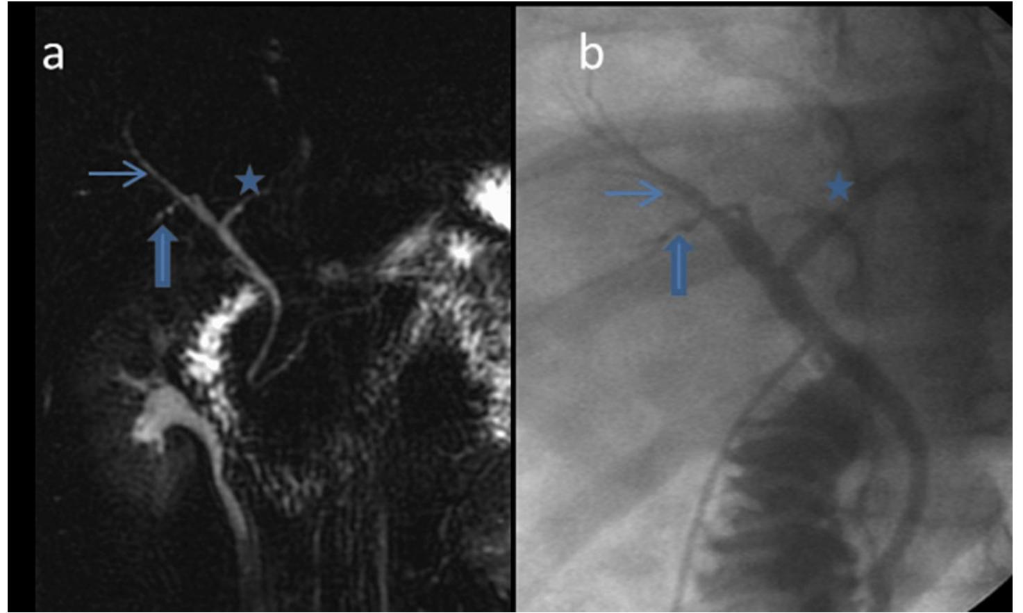 (PDF) Our Experience in Tracking the Tract: Normal Biliary Anatomy and ...