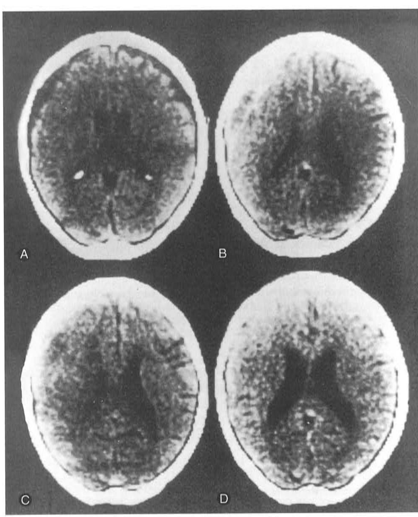 (PDF) Non-operative treatment of chronic subdural hematoma: Case report