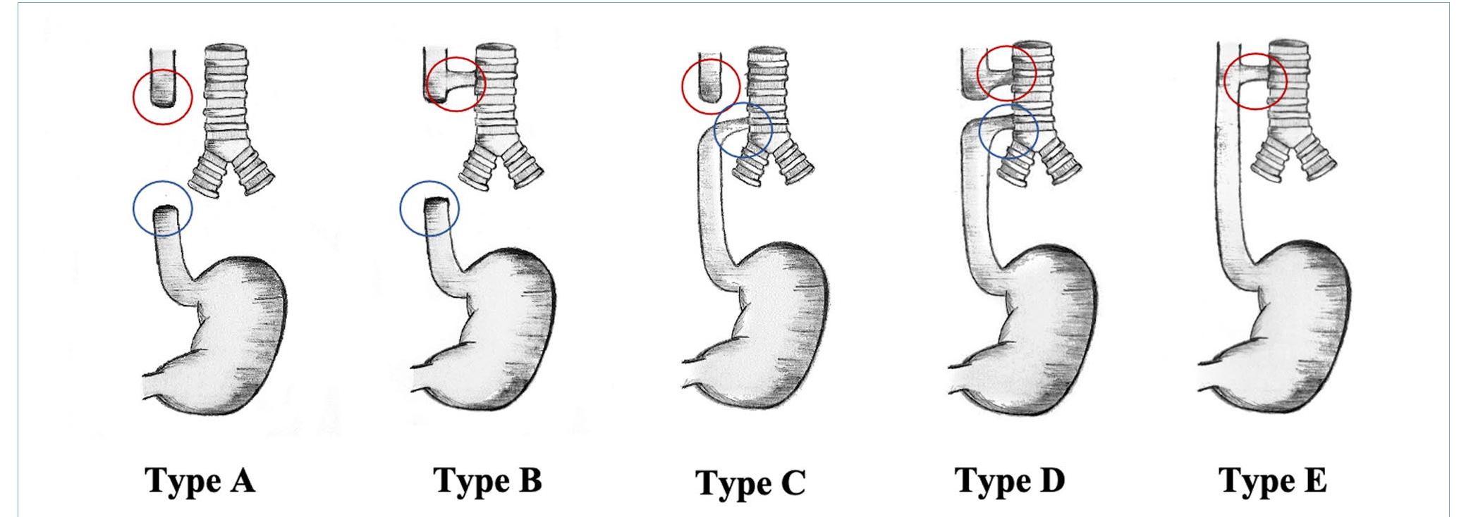 Tef Classification (PDF) Congenital anomalies of the tubular gastrointestinal tract