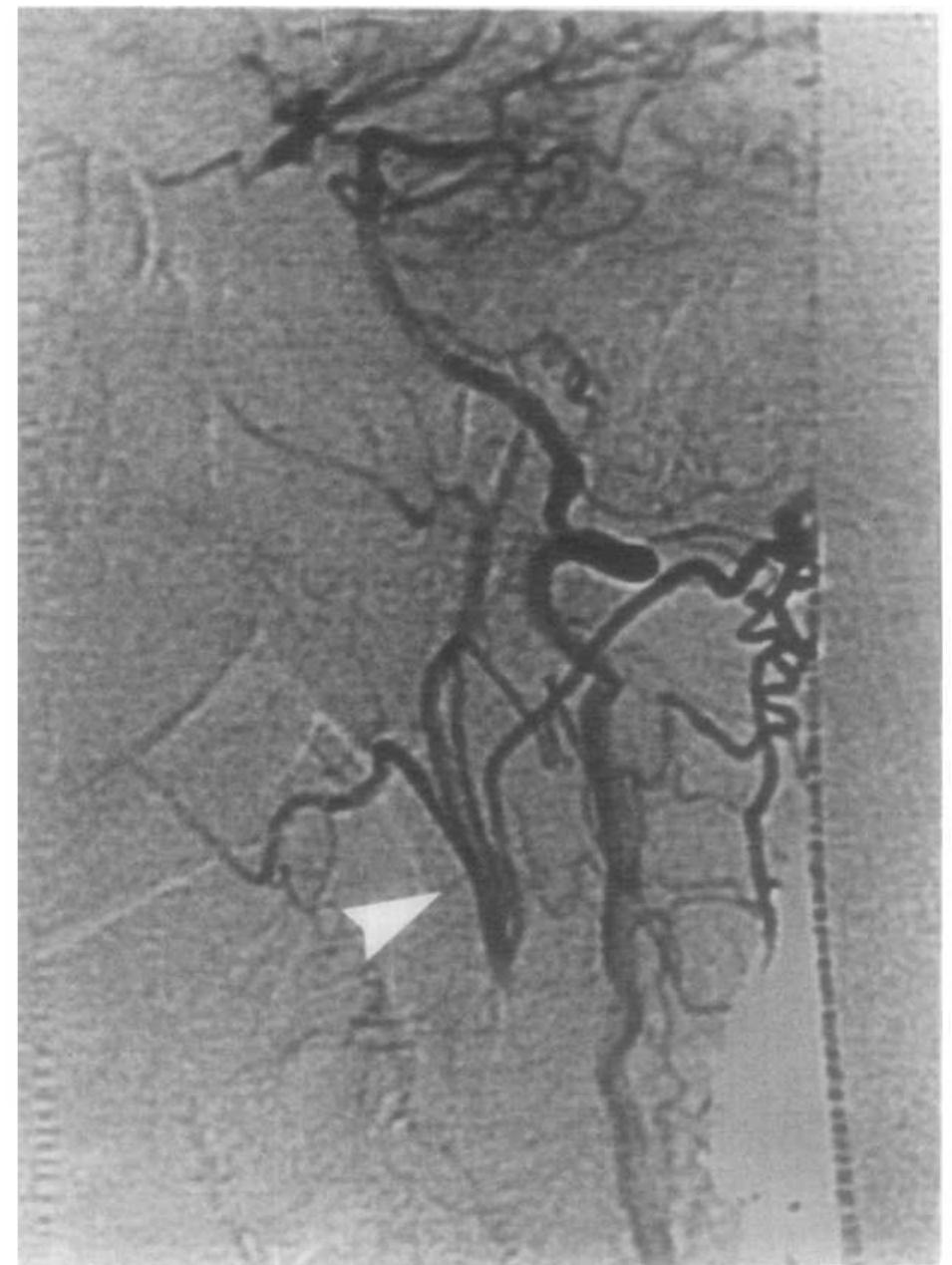 (PDF) Digital subtraction angiography: Intravenous and intra-arterial ...