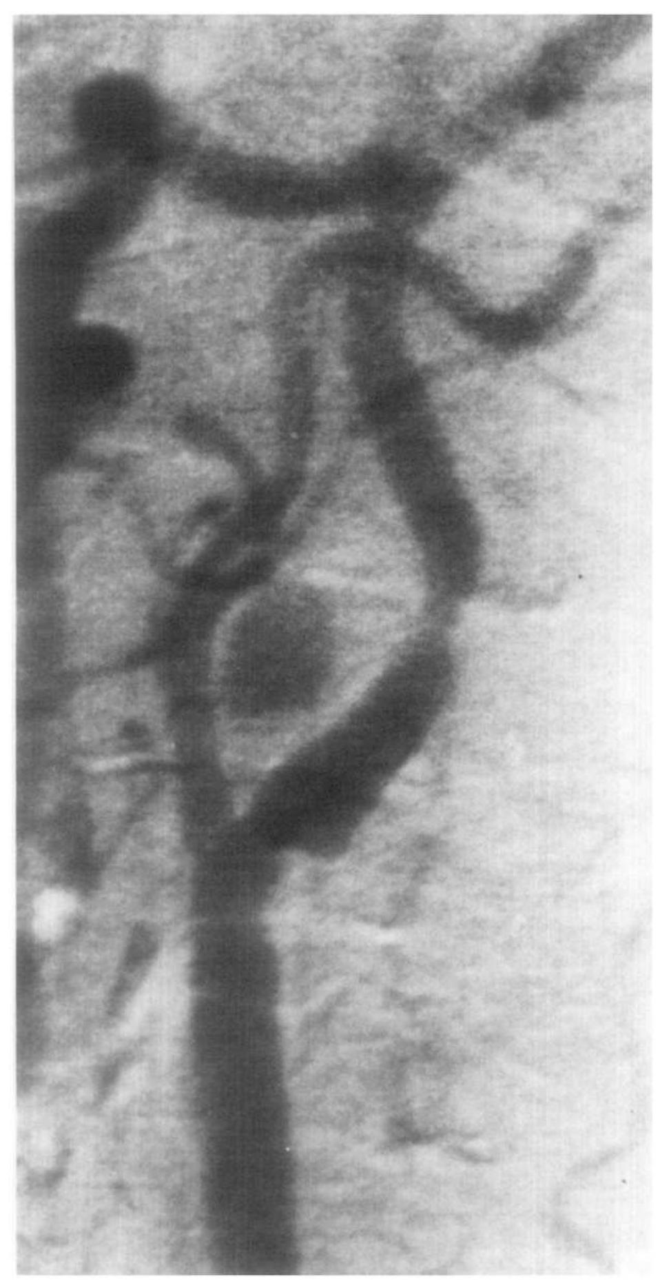 (PDF) Digital subtraction angiography: Intravenous and intra-arterial ...