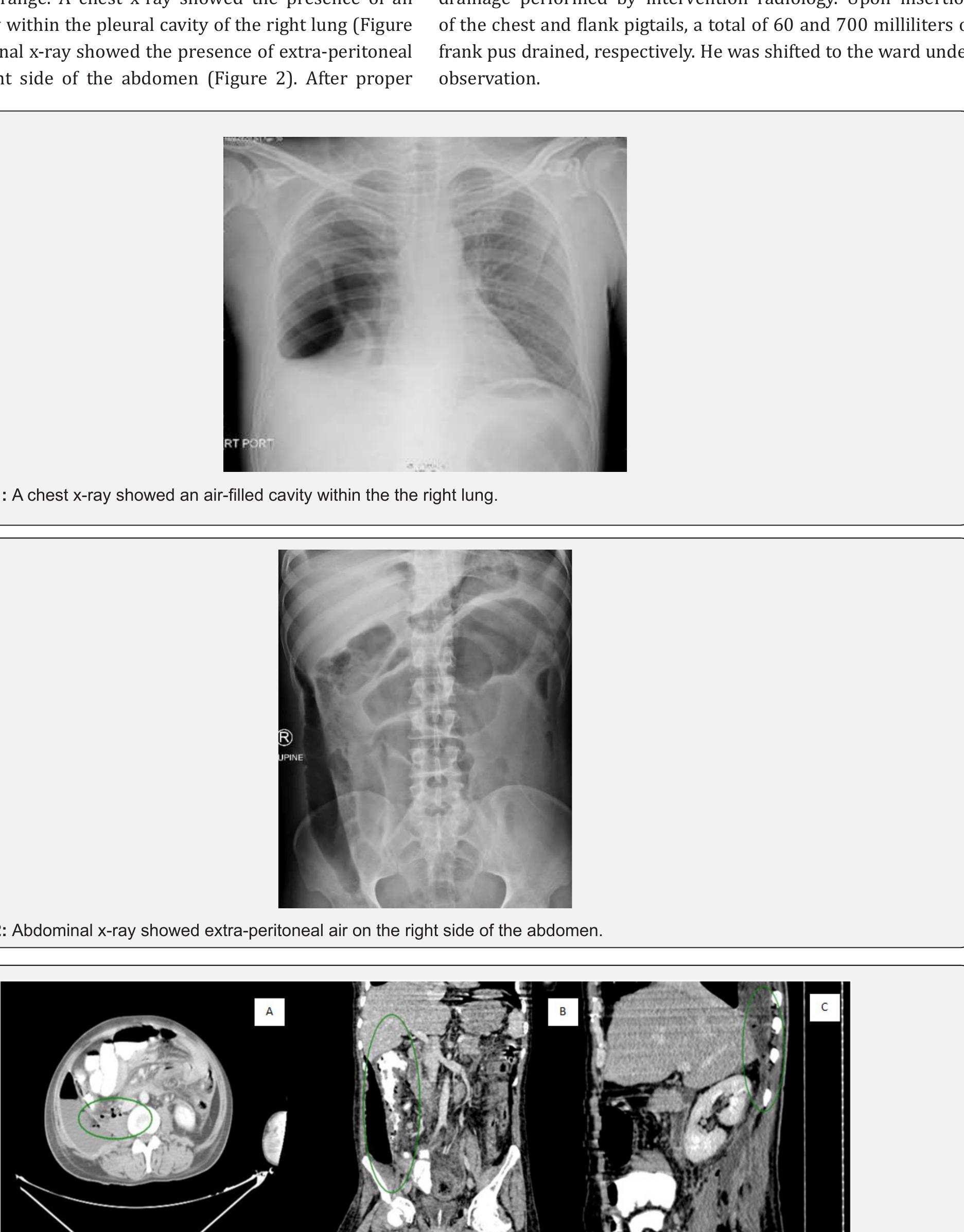 (PDF) Fournier Gangrene, Empyema and Retroperitoneal Abscess as a Rare ...