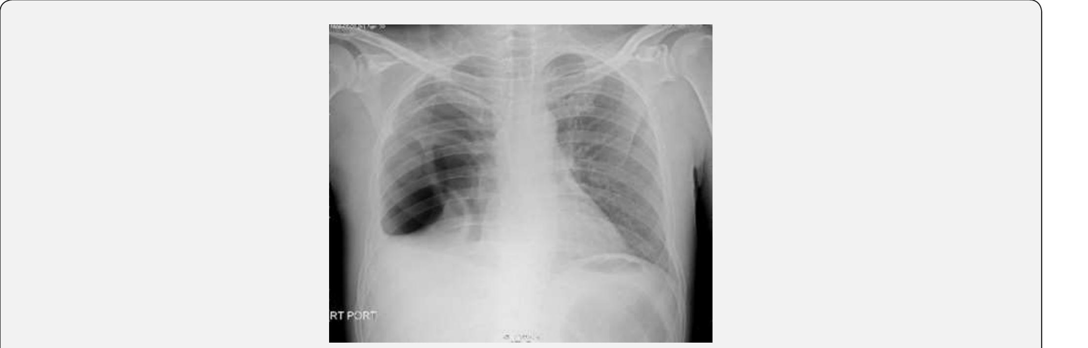 (PDF) Fournier Gangrene, Empyema and Retroperitoneal Abscess as a Rare ...