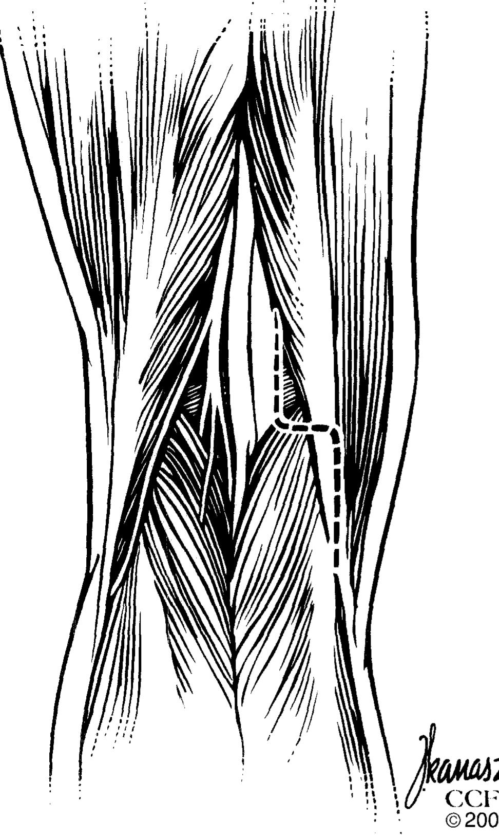 Pcl Inlay (PDF) Tibial inlay procedure for PCL reconstruction: One tunnel and two ...