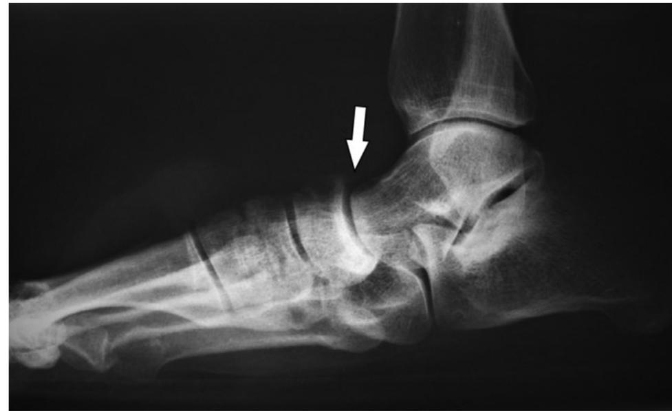Ig. 17. endoscopic view of a torn spring ligament. (a)