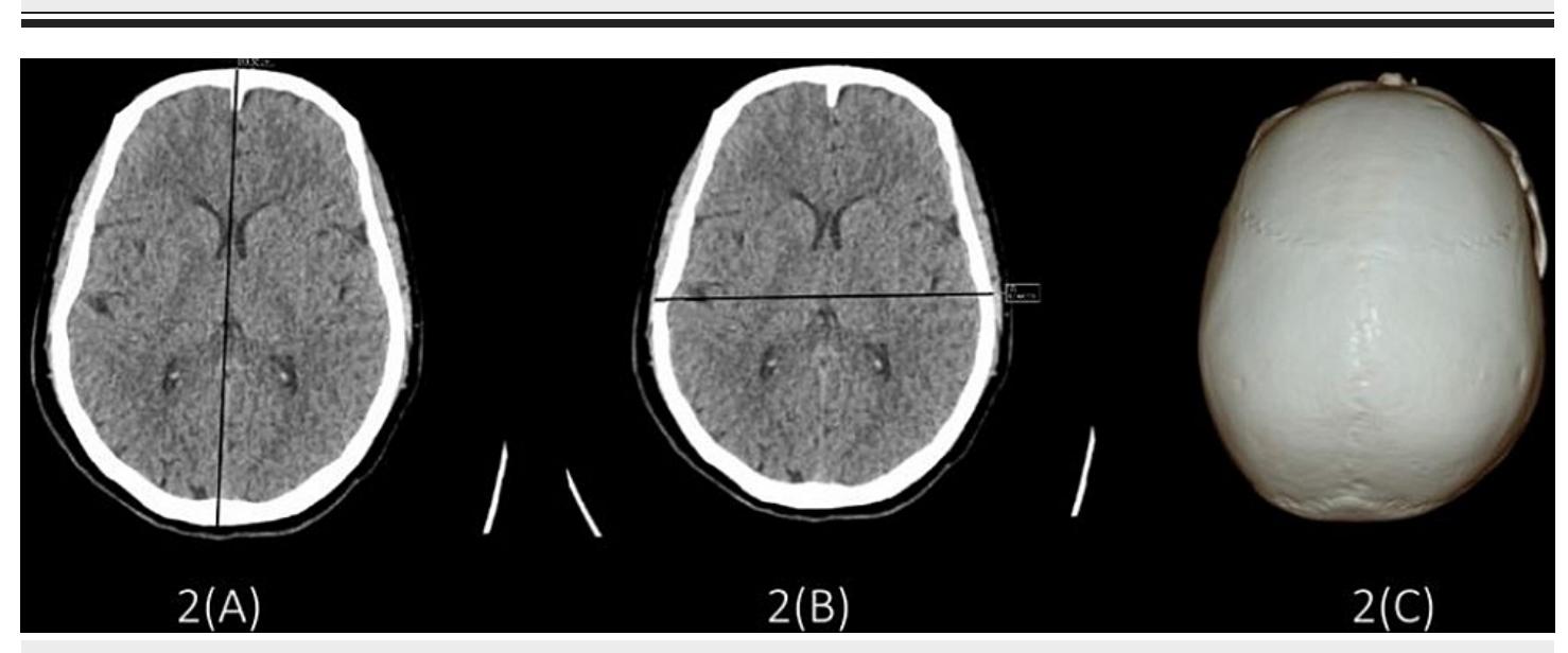 Cephalic Index 91 Example (PDF) Establishment of Cephalic Index Using Cranial Parameters by ...