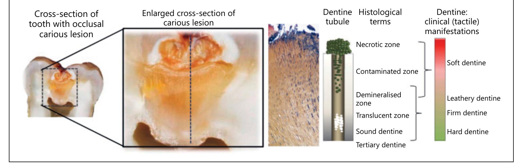 Static Caries (PDF) Pathophysiology of Dental Caries