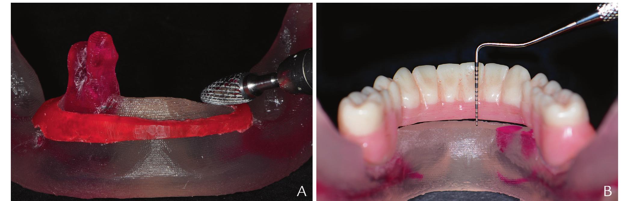 Surface Resin Ridges Figure 3 - from Combining guided alveolar ridge reduction