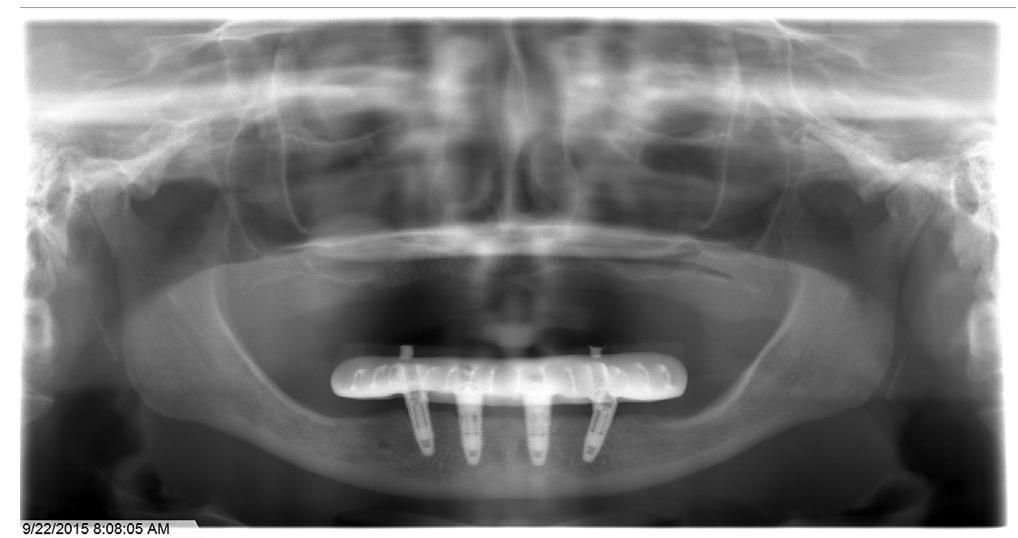 Figure 8 - from Combining guided alveolar ridge reduction