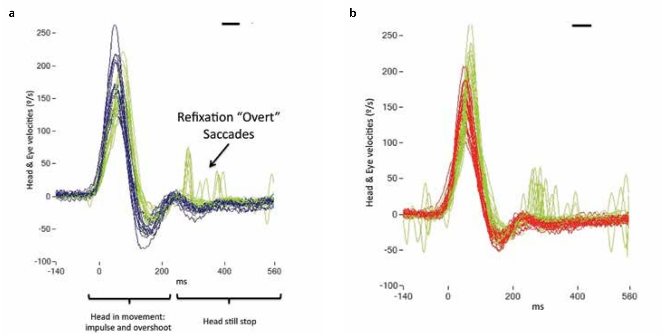 Normal Vor (PDF) Normal Gain of VOR with Refixation Saccades in Patients with ...