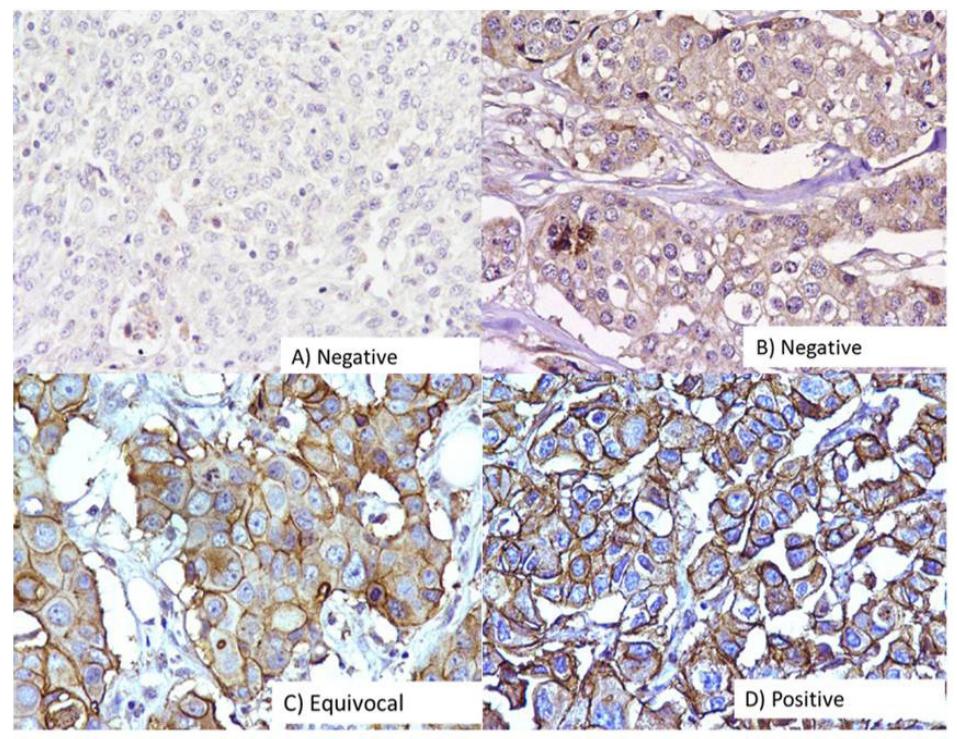 Immunohistochemical analysis of her2 in breast carcinomas.